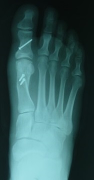X-ray of a surgically corrected foot